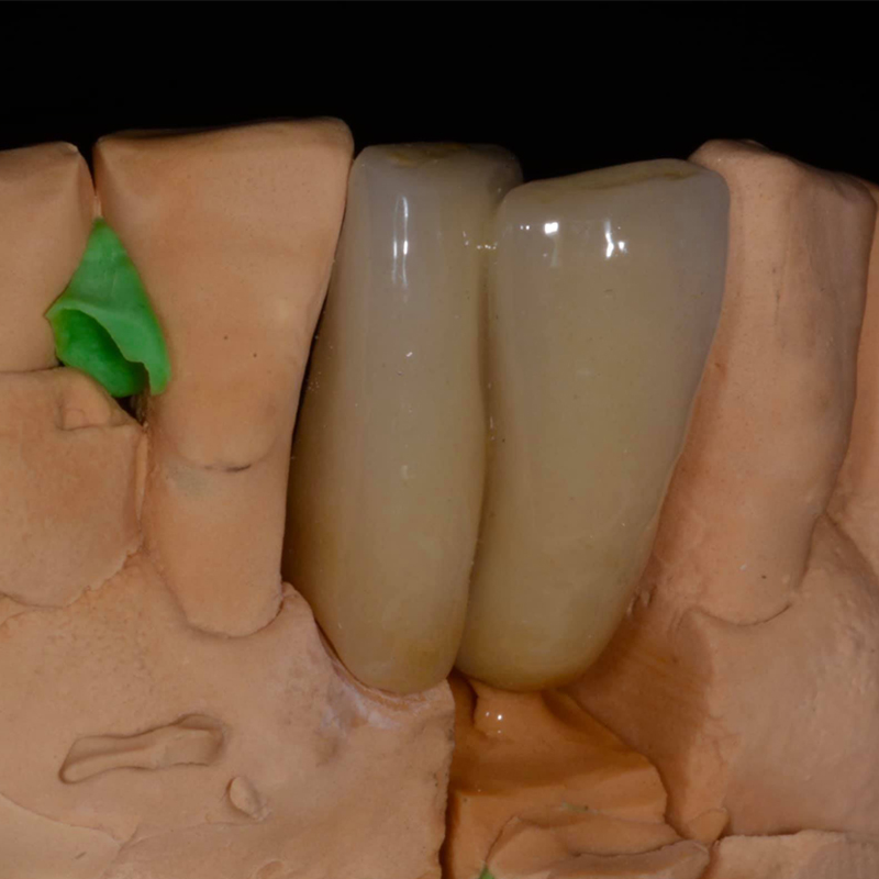 Chi è adatto per i denti in porcellana?