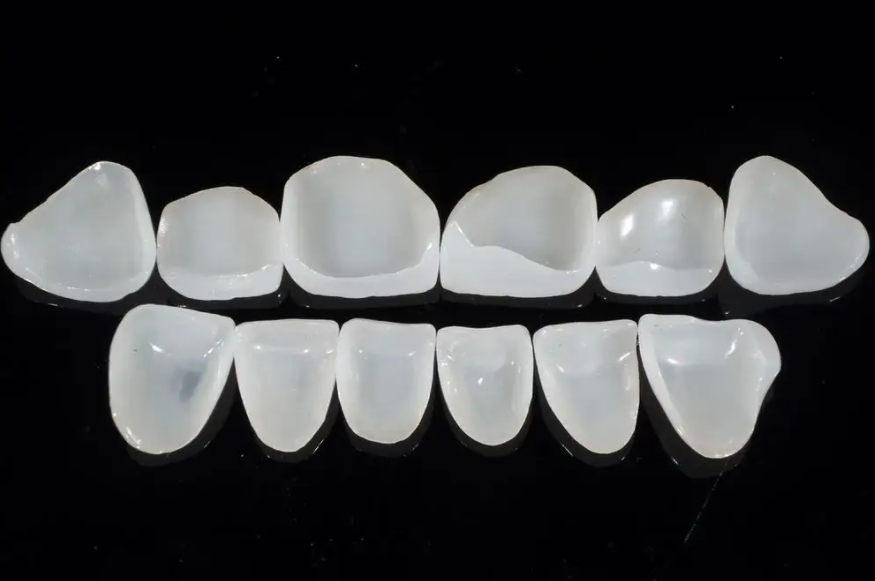 Quali sono i vantaggi delle faccette dentali?