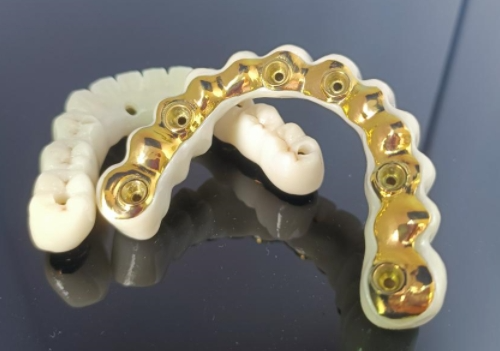 Barra implantare in titanio CAD/CAM+ponte in zirconio