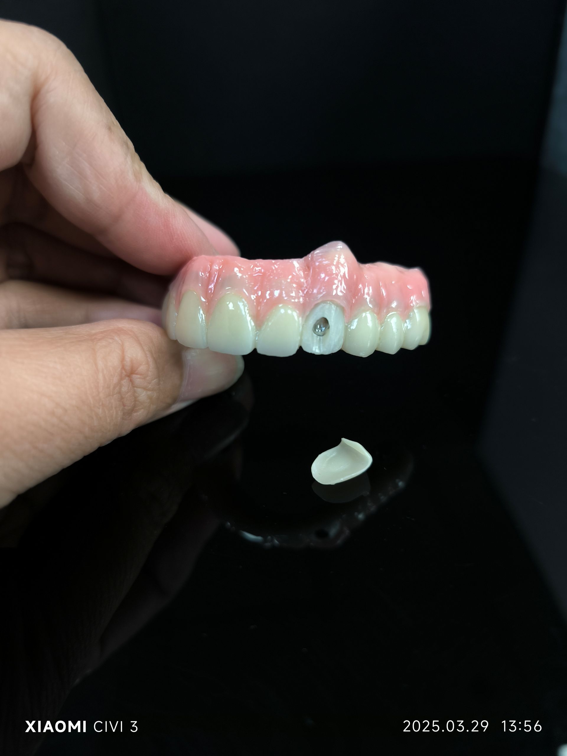 Tutto su 4 - soluzione di ponte zirconico ibrido per foro di vite vestibolare