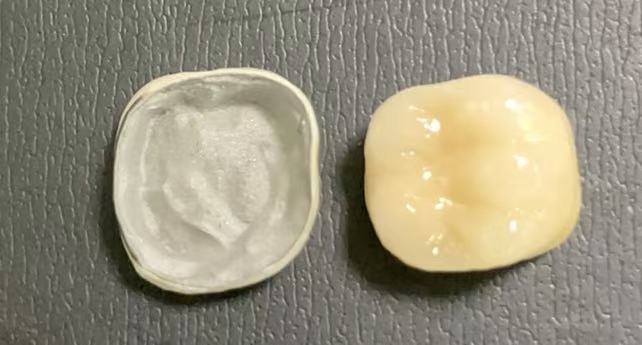 Quali condizioni sono necessarie per ottenere corone fusi a metallo in porcellana?