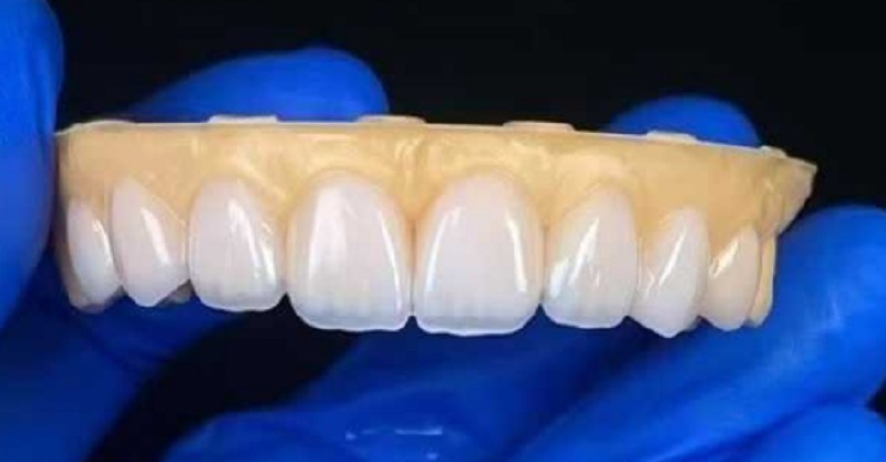 Impiallacciature dentali per riparare il problema delle lacune eccessive dei denti