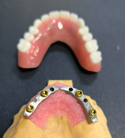 Localizzatore e barra dentale in titanio