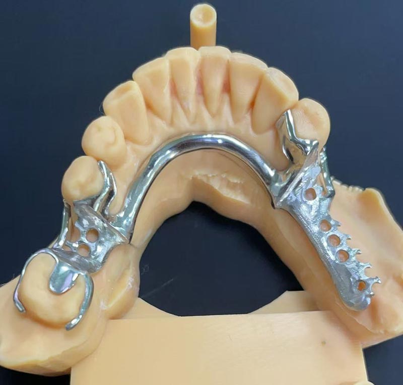 Vantaggi della struttura in cobalto-cromo (Co Cr Framework)