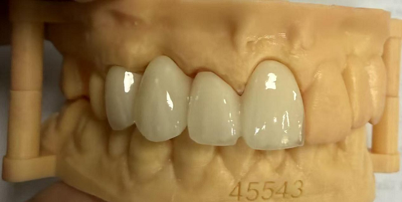 Perché i bordi delle corone dentali diventano neri? E come risolverlo