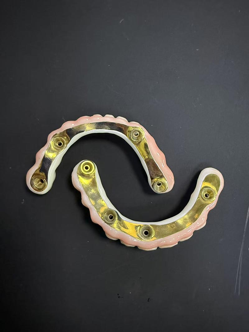 Vantaggi e svantaggi dell'overdenture supportata da impianti Bar-Clip