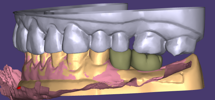 La ceratura estetica e i restauri provvisori di WM Dental Lab ottengono il plauso unanime dei clienti