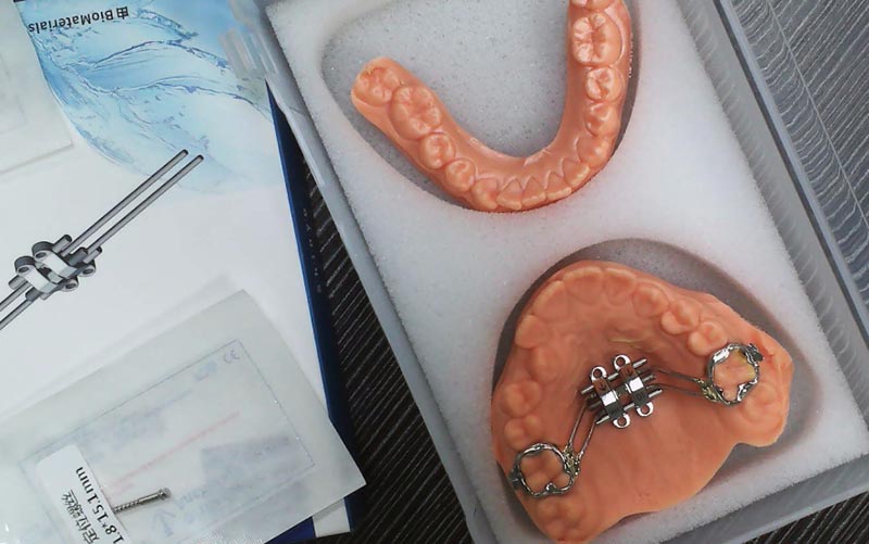 Comprendere l'espansione scheletrica MSE con WM Dental Lab