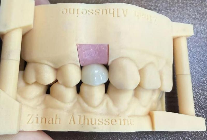 Sicurezza e precauzioni degli impianti dentali