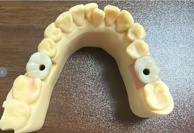 Perché l'impianto dei denti anteriori è più difficile dell'impianto dei denti posteriori?