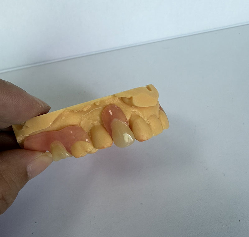 Parziali Valplast presso WM Dental Lab