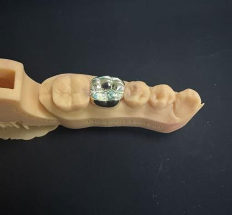 Denti d'oro VS Denti NPG