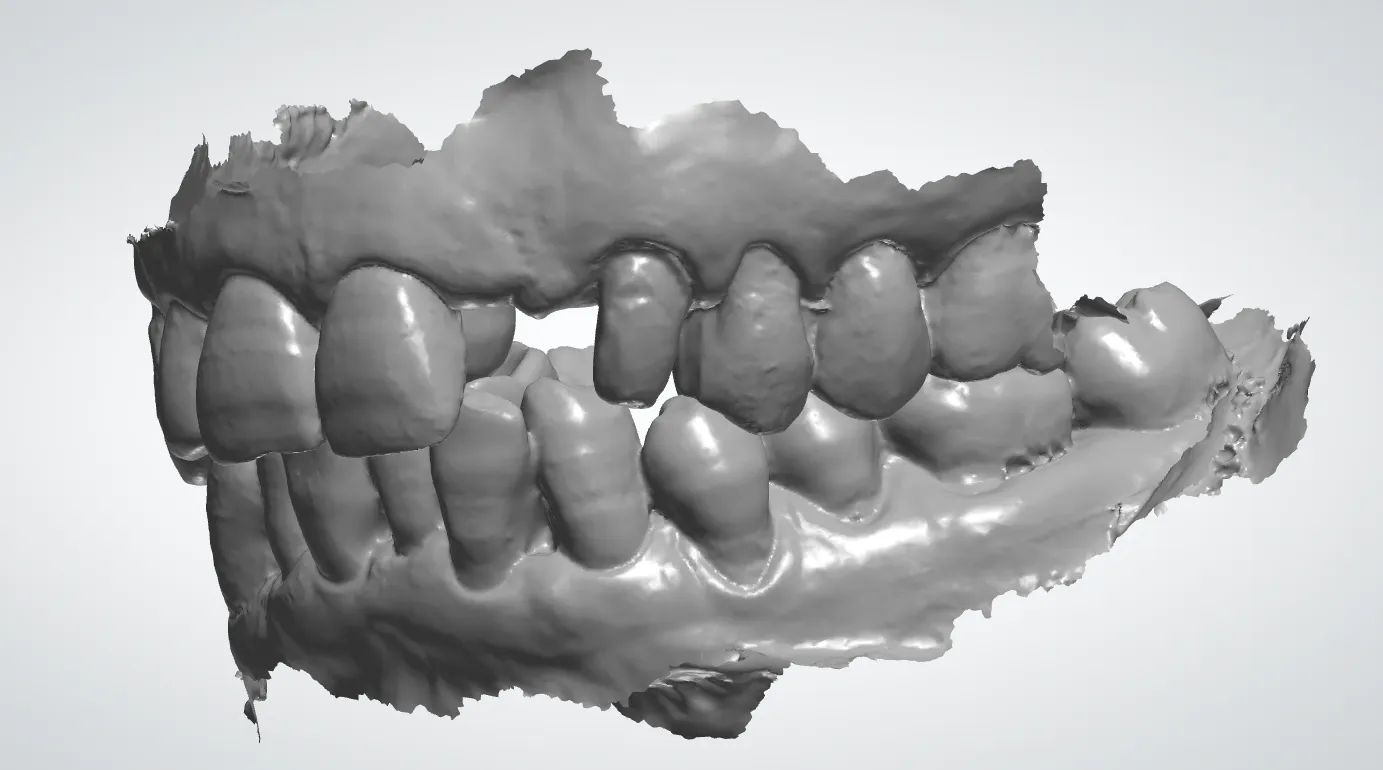 Ripristina il tuo sorriso: soluzioni leader per i denti mancanti