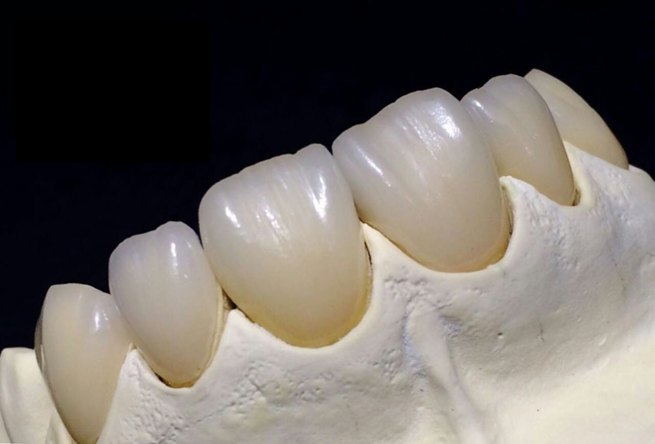 Corona interamente in ceramica