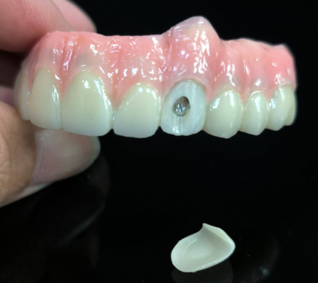 Tutto su 4 la soluzione ibrida - ponte zirconico ibrido per foro per vite vestibolari