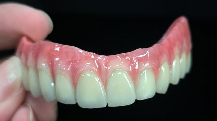 All on 4 Hybrid - Malo Bridge Full Zirconia Crowns sulla struttura del titanio