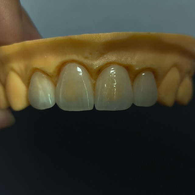 Impiallacciatura dentale Emax stratificata ad alta traslucenza