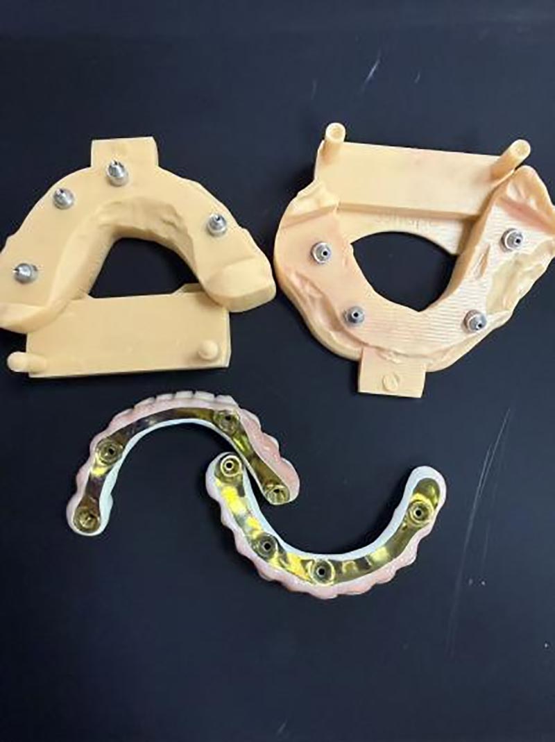 bar-clip implant-retained