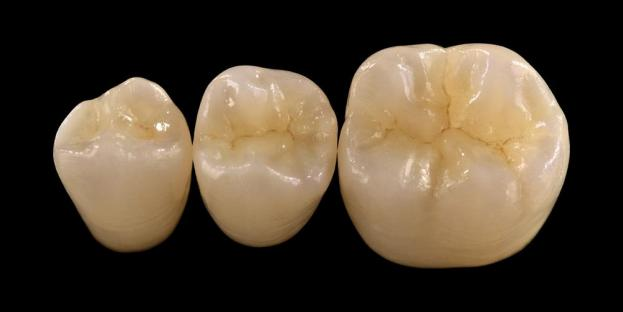<h2>Zirconia in odontoiatria: indicazioni, vantaggi e considerazioni cliniche</h2>
<p>La zirconia è ampiamente riconosciuta per la sua resistenza e durata. Le ultime generazioni di materiali in zirconio offrono anche proprietà estetiche notevolmente migliorate. Per i pazienti che considerano restauri in ceramica integrale, è essenziale valutare attentamente sia le indicazioni che i limiti dei sistemi basati su zirconia.</p>
<p>I pazienti di oggi si aspettano sempre più restauri che combinino un’estetica eccellente con prestazioni funzionali complete. La maggior parte dei moderni sistemi ceramici può soddisfare queste aspettative, ma il successo clinico dipende in gran parte dalla corretta selezione del materiale, dalla preparazione del dente e dai protocolli di cementazione. La scelta dovrebbe essere guidata dalle proprietà chiave del materiale come resistenza alla frattura, resistenza alla flessione, resistenza all'usura e stabilità a lungo termine. Tra questi materiali, la zirconia è diventata una delle opzioni più utilizzate nell’odontoiatria restaurativa contemporanea.</p>
<h3>Perché scegliere la zirconia?</h3>
<p>La zirconia è apprezzata per la sua eccezionale resistenza e durata a lungo termine. La zirconia moderna è significativamente diversa dalle generazioni precedenti, che erano più opache e meno estetiche. Oggi, la tecnologia CAD/CAM consente la realizzazione precisa di restauri in zirconia con proprietà ottiche migliorate.</p>
<p>I restauri possono essere progettati come:</p>
<ul>
<li><strong>Zirconia monolitica:</strong>Ideale per corone e ponti posteriori, offre elevata resistenza e durata.</li>
<li><strong>Zirconia stratificata:</strong>Adatto per casi che richiedono un'estetica migliorata, compresi restauri di lunga durata su diverse aree della bocca.</li>
</ul>
<p>La resistenza alla flessione varia a seconda del tipo, da circa 590 MPa nella zirconia ad alta traslucenza fino a 1400 MPa nelle forme monolitiche. I restauri in zirconio possono essere cementati utilizzando cementi resinosi autoadesivi o cementi vetroionomerici modificati con resina.</p>
<h3>Fattori chiave nella scelta del materiale in zirconio</h3>
<p>Quando si considera la zirconia per un restauro in ceramica integrale, i medici dovrebbero valutare diversi fattori critici:</p>
<ul>
<li>Struttura dentale rimanente</li>
<li>Posizione nella cavità orale (zona estetica vs zona funzionale)</li>
<li>Presenza di abitudini parafunzionali come il bruxismo</li>
<li>Traslucenza dei denti naturali adiacenti</li>
<li>Colore e condizione della struttura dentale sottostante</li>
</ul>
<p>La zona estetica comprende tipicamente i denti anteriori, anche se in alcuni pazienti può estendersi al primo molare a seconda della linea del sorriso e delle dinamiche facciali. La zona funzionale comprende generalmente premolari e molari, dove le forze occlusali sono significativamente più elevate.</p>
<h3>Applicazioni delle zone funzionali</h3>
<p>Nelle regioni posteriori è necessario considerare attentamente le forze occlusali. La zirconio è un'eccellente alternativa ai tradizionali restauri PFM, soprattutto nei casi con spazio restaurativo limitato. La moderna zirconia monolitica consente la progettazione a contorno completo dell'anatomia occlusale, comprese cuspidi funzionali e creste marginali, pur mantenendo un'elevata resistenza.</p>
<p>Le prove attuali dimostrano che la zirconia monolitica è particolarmente adatta per corone posteriori e ponti a più unità grazie alla sua eccellente resistenza alla frattura e all’usura. I progressi nelle tecniche adesive e nella progettazione delle preparazioni hanno anche migliorato i risultati clinici a lungo termine.</p>
<h3>Applicazioni della zona estetica</h3>
<p>Nella regione anteriore, i restauri devono replicare fedelmente il colore naturale del dente, la traslucenza e il comportamento alla luce. Sebbene materiali come il disilicato di litio offrano un'estetica eccellente, sono meno resistenti e in genere richiedono un fissaggio adesivo.</p>
<p>Un vantaggio chiave della zirconia è la sua capacità di essere cementata convenzionalmente pur ottenendo elevate prestazioni estetiche. Con lo sviluppo di sistemi di zirconio ad alta traslucenza e multistrato, è ora possibile produrre restauri che imitano fedelmente la dentatura naturale.</p>
<p>Le tecniche di lavorazione avanzate migliorano ulteriormente le proprietà ottiche e riducono le imperfezioni che possono influenzare la trasmissione della luce e l'aspetto.</p>
<h3>Forza ed estetica combinate</h3>
<p>I primi sistemi in zirconio davano priorità alla resistenza ma mancavano di qualità estetica. La moderna zirconia monolitica combina con successo sia la resistenza che l'aspetto migliore, rendendola adatta ad un'ampia gamma di casi clinici.</p>
<p>È particolarmente vantaggioso per i pazienti con abitudini parafunzionali o precedenti fallimenti di restauro. Gli studi clinici indicano un’elevata accettazione da parte dei pazienti e bassi tassi di complicanze.</p>
<p>I problemi relativi all'usura sui denti opposti sono stati ridotti con le formulazioni più recenti. Le superfici in zirconio altamente lucidate dimostrano un basso potenziale abrasivo e in alcuni casi possono essere più delicate rispetto ai tradizionali restauri in porcellana fusa su metallo.</p>
<h3>Impianti in zirconio: alternativa emergente</h3>
<p>Mentre gli impianti in titanio rimangono lo standard clinico, gli impianti in zirconio stanno guadagnando attenzione come alternativa priva di metalli. I primi progetti erano principalmente sistemi monopezzo, ma gli impianti in zirconio a due pezzi ora consentono una migliore flessibilità protesica.</p>
<p>Gli impianti in zirconio sono particolarmente utili nei casi in cui esistono problemi estetici, come la potenziale colorazione grigia dei tessuti perimplantari o il biotipo gengivale sottile. Possono anche essere presi in considerazione per i pazienti con rara sensibilità al titanio.</p>
<p>Tuttavia, gli impianti in zirconio sono ancora relativamente nuovi e i dati clinici a lungo termine rimangono limitati rispetto ai sistemi in titanio.</p>
<h3>Conclusione</h3>
<p>La zirconia si è evoluta in un materiale altamente versatile nell'odontoiatria restaurativa, offrendo un forte equilibrio tra prestazioni meccaniche ed estetica. La corretta selezione del caso e il rispetto dei protocolli clinici sono essenziali per ottenere risultati ottimali sia nelle applicazioni anteriori che posteriori.</p>