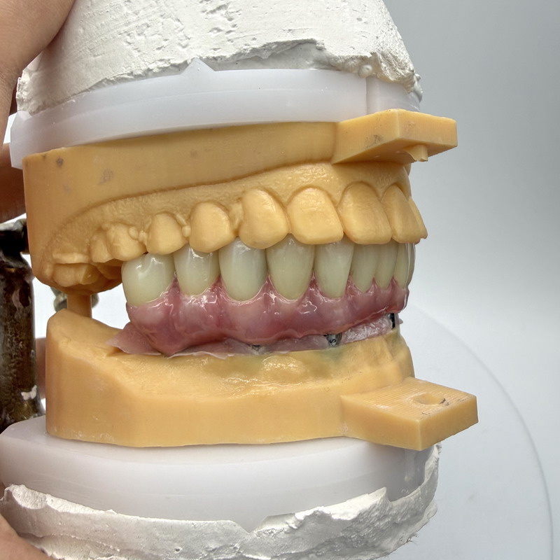 Malo Bridge con Meharry Gum per i neri
